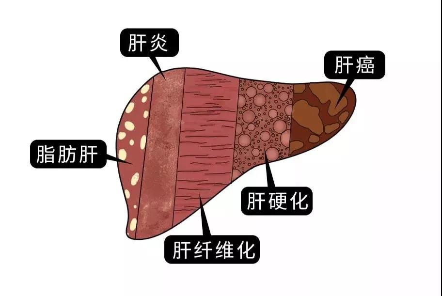 脂肪肝的最大敵人不是肥胖，答案竟是這樣！