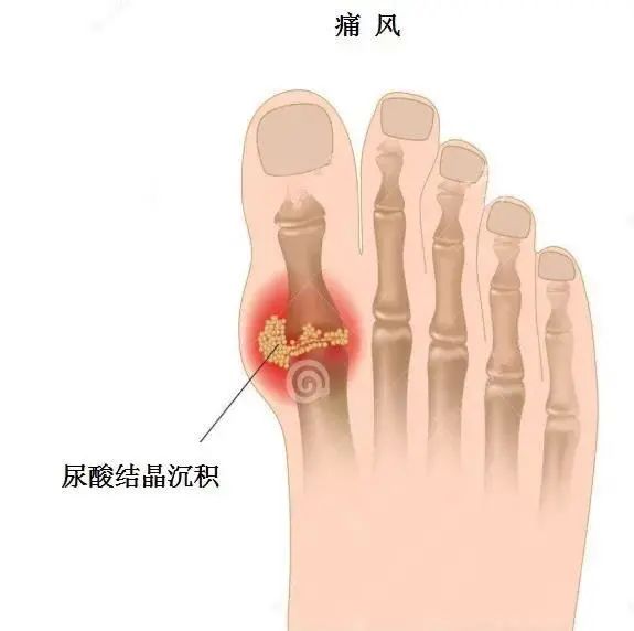 痛風(fēng)為什么偏愛男性？你最關(guān)心的問題都在這里