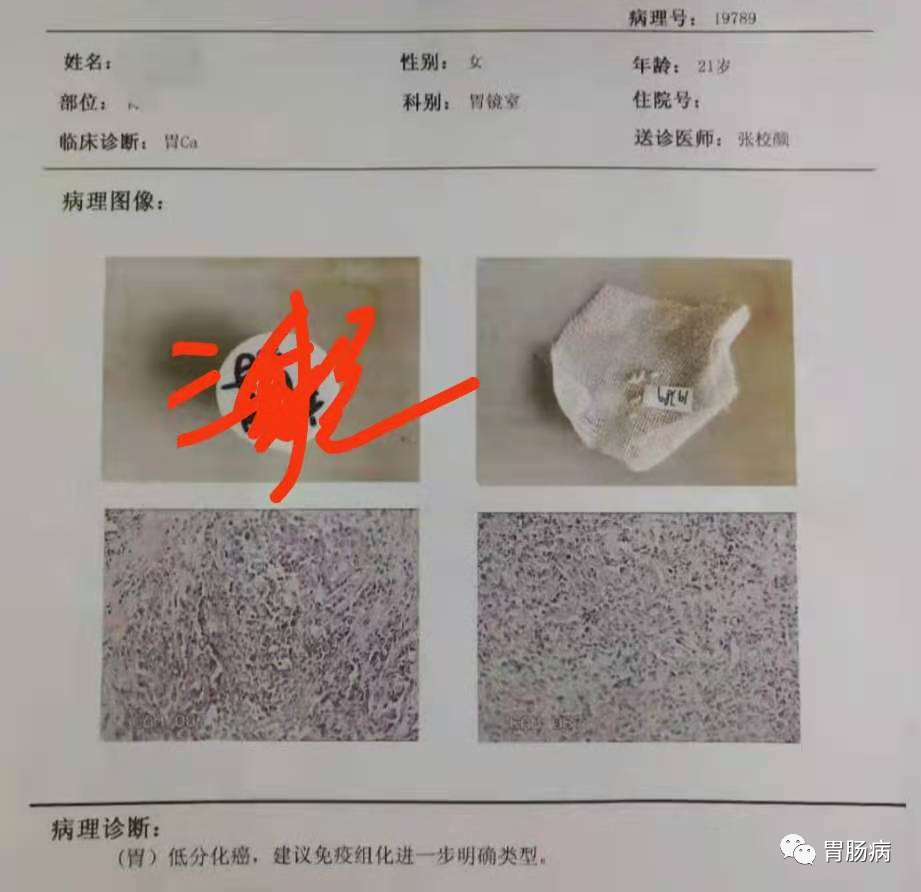 醫(yī)生總結(jié)了3位年輕胃癌患者的病例：30歲不到的他們到底干啥了？