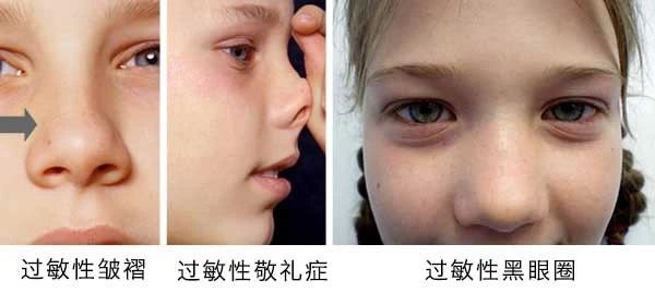 過敏性鼻炎會讓孩子變傻？！家長該如何應(yīng)對